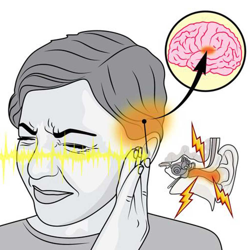 Tinnitus